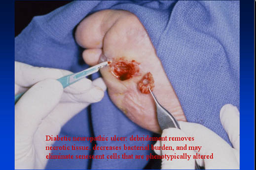 Diabetic neuropathic ulcer