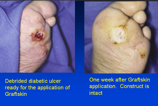 Debrided diabetic ulcer ready for the application of Graftskin and one week after Graftskin application