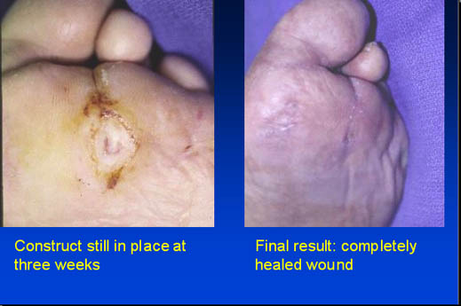 Construct still in place at 3 weeks and final result