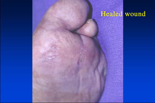 Healed wound