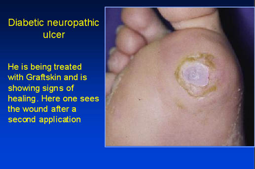 Diabetic neuropathic ulcer