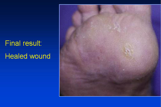 Final result: healed wound