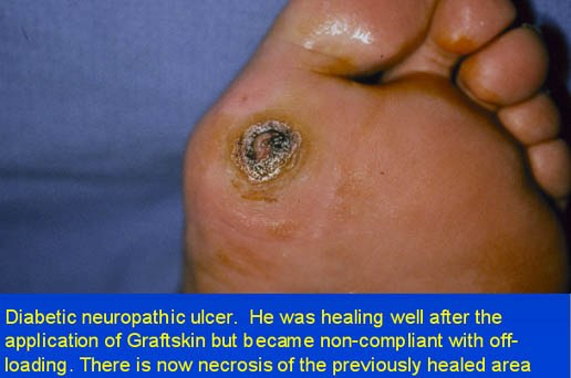 Diabetic neuropathic ulcer