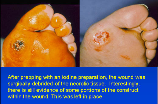 After prepping with an iodine preparation, the wound was surgically debrided of the necrotic tissue