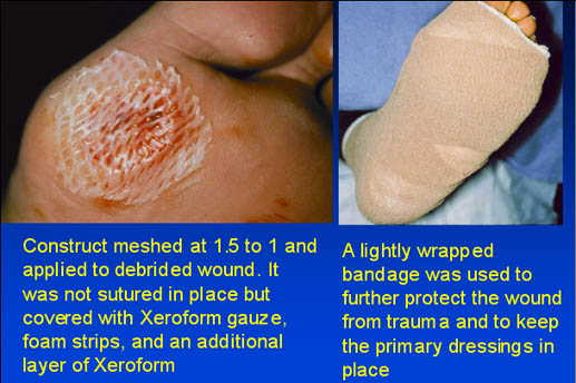 Construct meshed at 1.5 to 1 and applied to debrided wound
