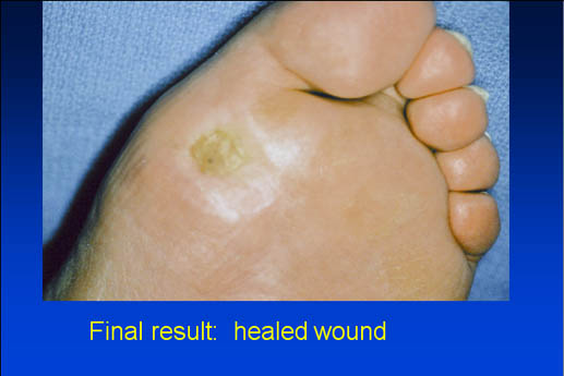 Final result: healed wound