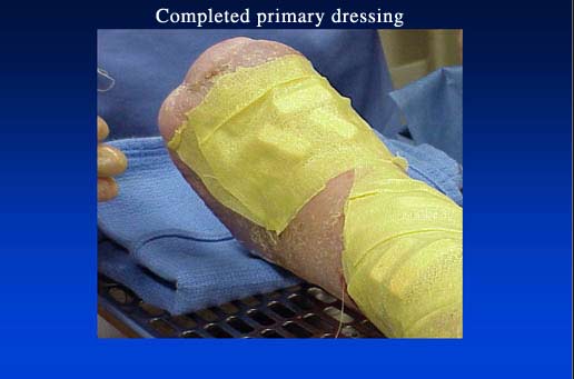 Completed primary dressing