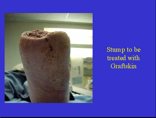 Stump to be treated with Graftskin