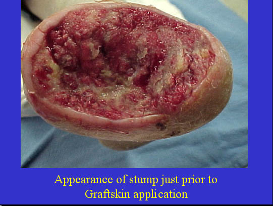 Appearance of stump just prior to Graftskin application