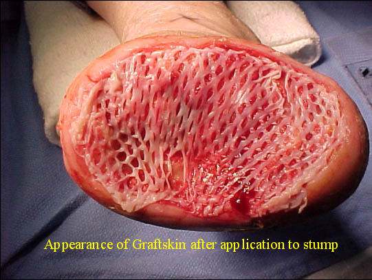 Appearance of Graftskin after application to stump