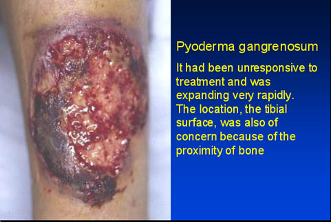 Pyoderma gangrenosum