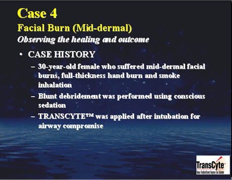 Case 4- Facial burn
