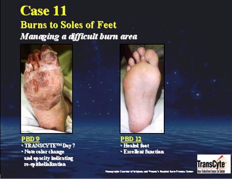 Case 11-Burns to the oles of the feet