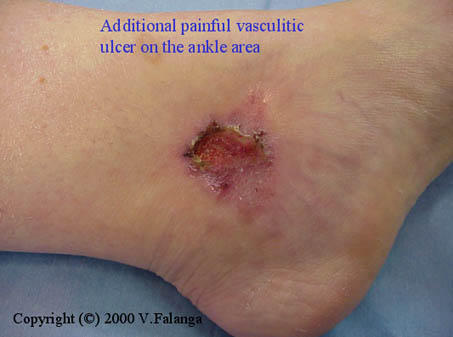 Painful vasculitic ulcer on ankle area