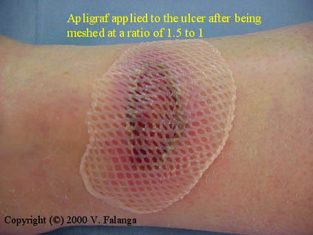 Apligraf applied to the ulcer after being meshed at a ratio of 1.5 to 1