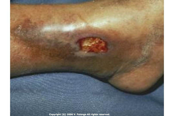 08 - Venous ulcerJPG