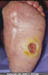 04 - Neuropathicdiabetic 