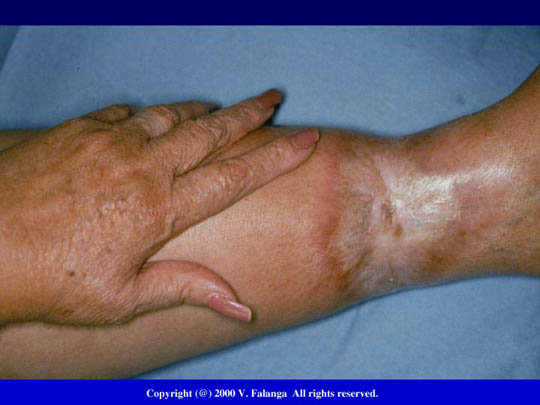 10b. Pyoderma gangrenosum and arthritis