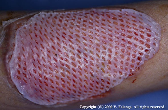 11c. Pyoderma gangrenosum in a young woman