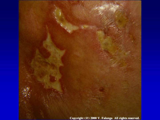 13. Angular ulcers in collagen vascular disease