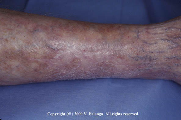 23b. Polyarteritis nodosa/Healed ulcer