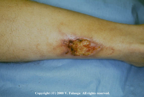 31a. Microlivedo and cryofibrinogenemia